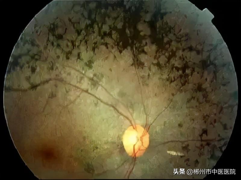 视锥细胞病变，深入了解与应对