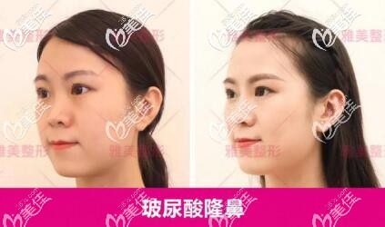 整鼻子的费用，了解价格背后的因素