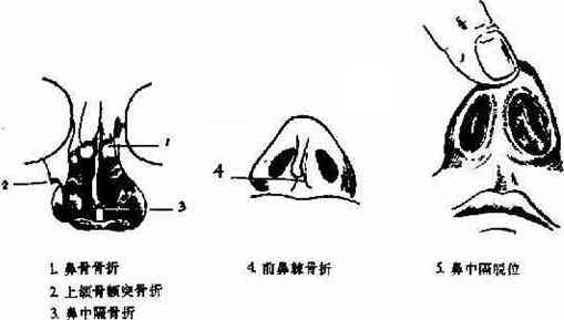 鼻子骨折了能自愈吗？解析鼻子骨折及其康复过程