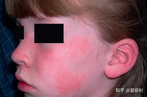 儿童皮肌炎，国内专家深度解读与治疗进展