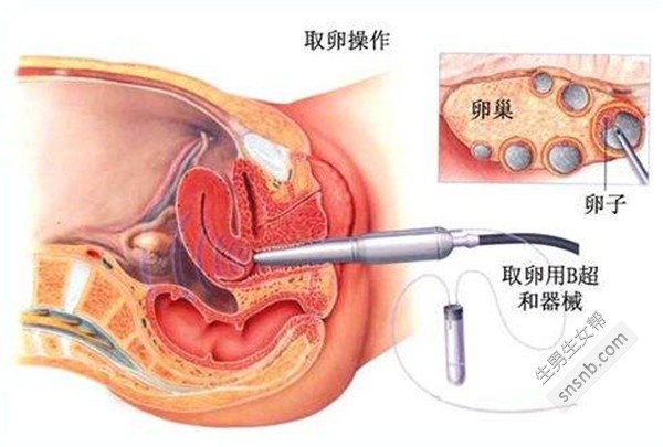 取卵注意事项，全方位解析与指导